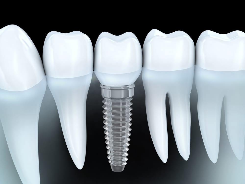 Dental-Implants.jpg